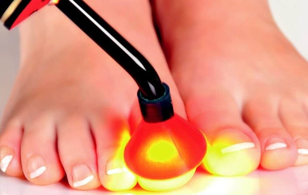 Traitement au laser de la plaque d'ongle