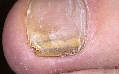Manifestations du champignon sur le pouce de la jambe