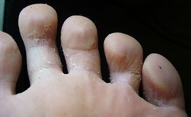 À quoi ressemble le champignon sur les jambes et comment le traitez-vous