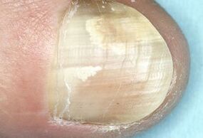 Dommages à la plaque à ongles causés par une infection fongique