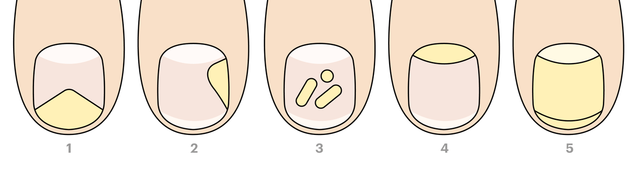 Types de champignons des ongles des pieds