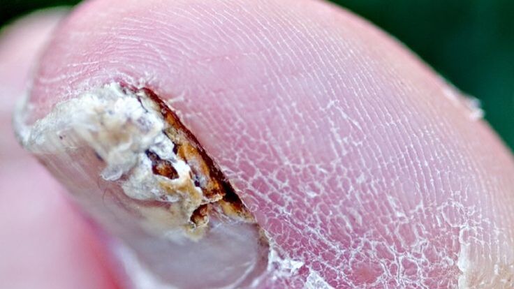 L'onychomycose est une infection fongique des ongles des pieds